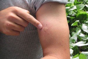 Как избавиться от опухоли после укуса пчелы