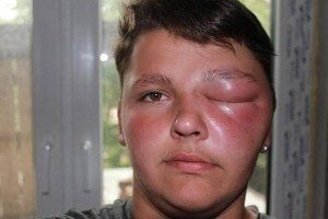Укус в лицо вызывает сильный отек